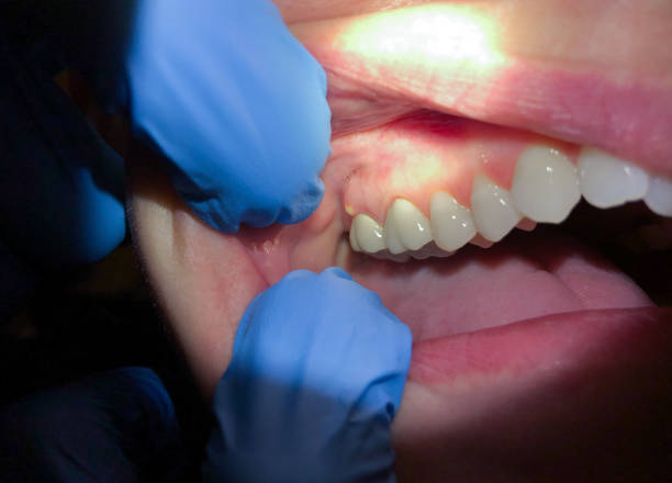 Best Emergency Dental Care for Broken or Chipped Teeth in Thiensville, WI